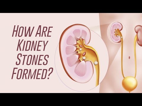 HOW KİDNEY STONES ARE FORMED?