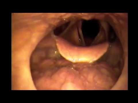 Where Snoring Comes From (Sleep Endoscopy)