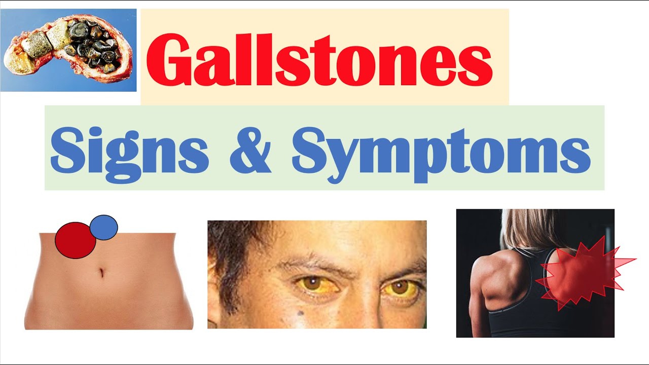 Gallstones Signs & Symptoms, Why They Occur | Cholecystitis, Choledocholithiasis, Cholangitis