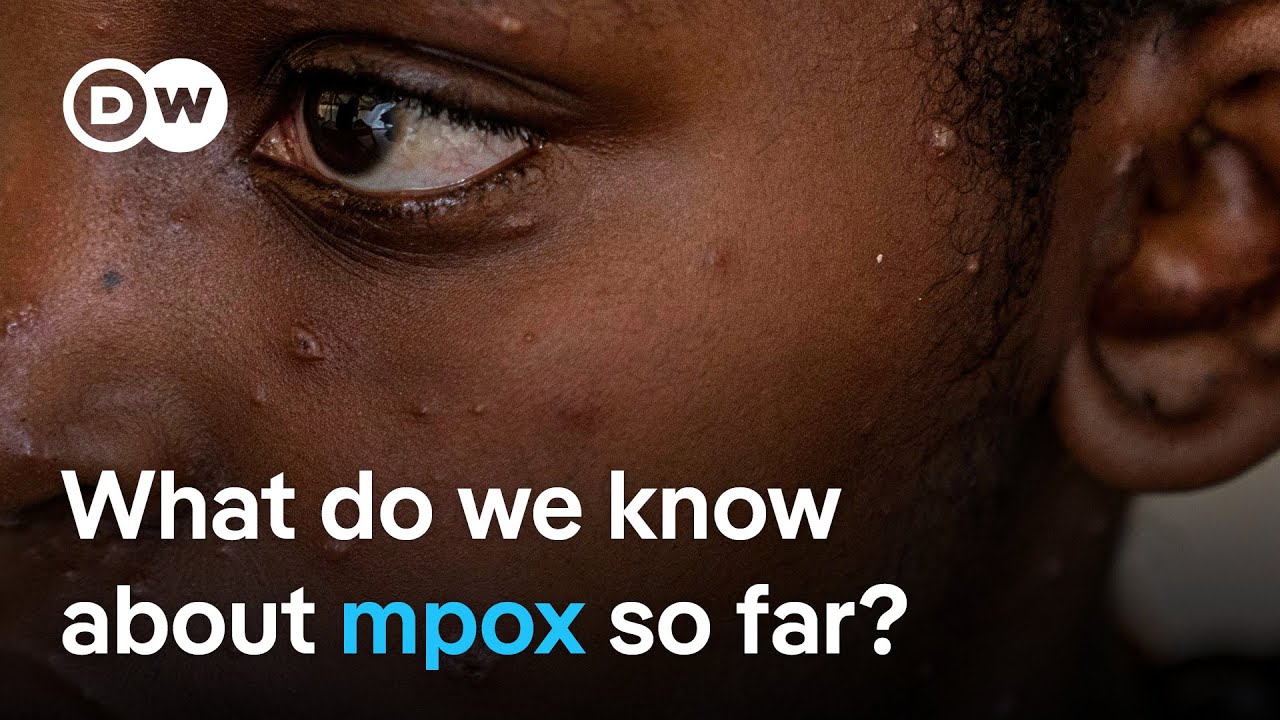 EU says further mpox cases are likely to be found soon in Europe   DW Analysis