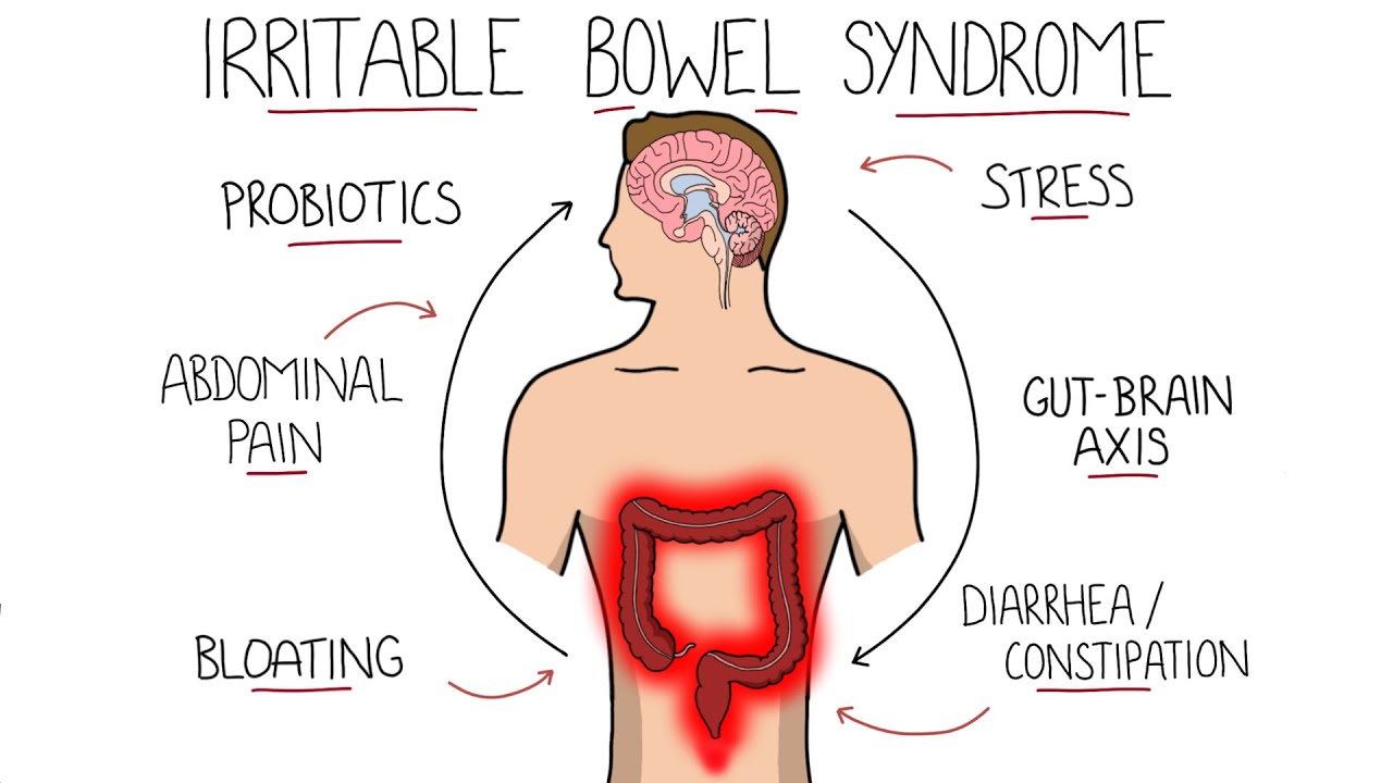 Irritable Bowel Syndrome (IBS) - Including Symptoms, Criteria  Treatment!