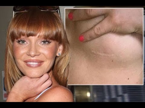 Summer Monteys-Fullam shows off her scar after terrifying breast cancer scare