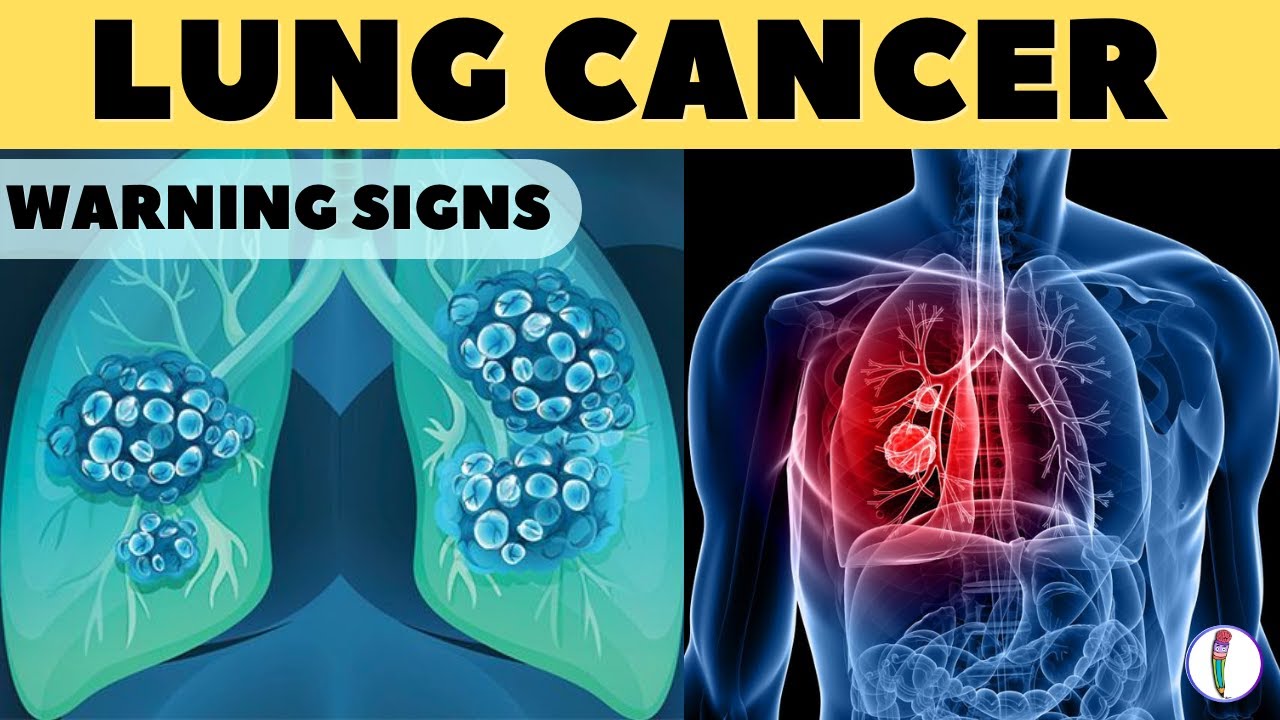 LUNG CANCER WARNİNG SİGNS II LUNG CANCER SYMPTOMS