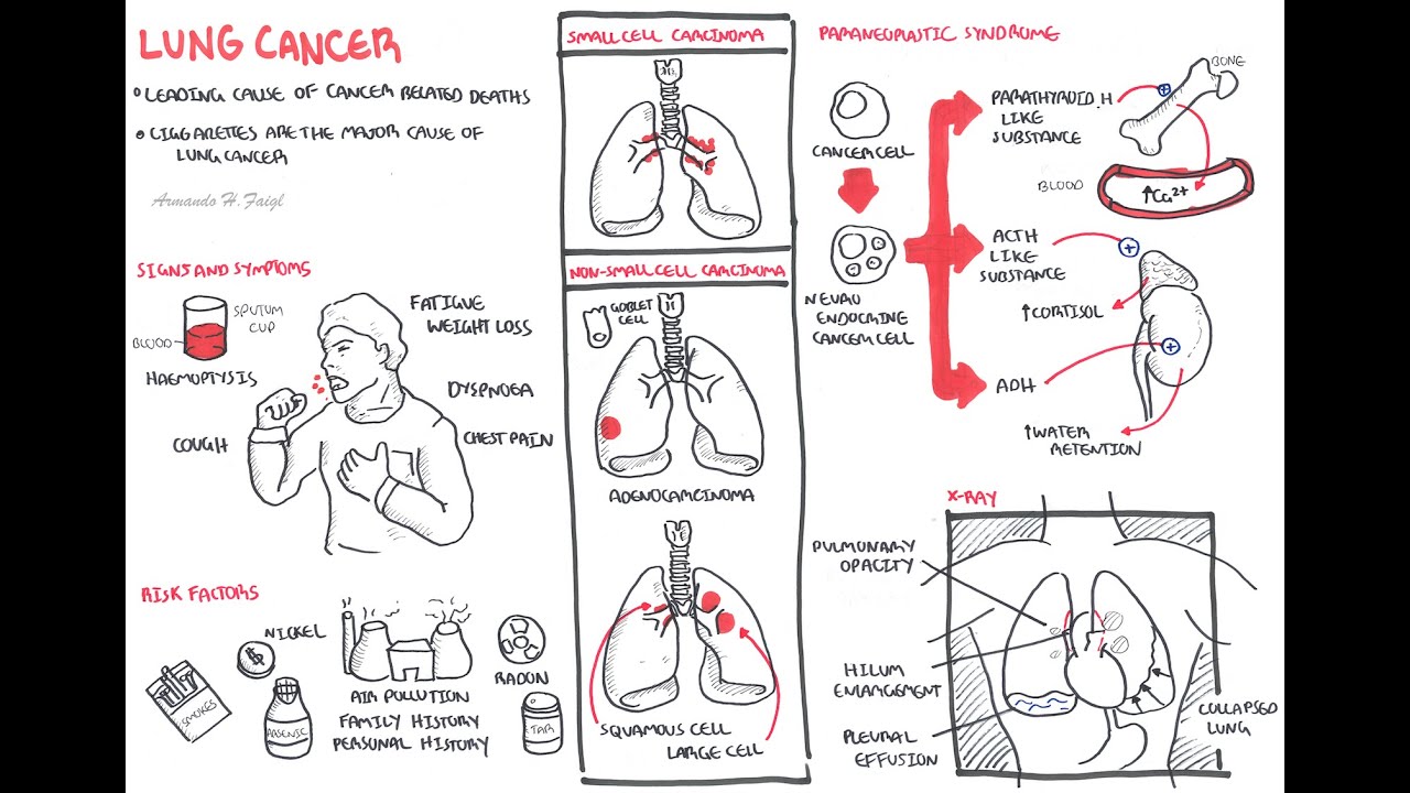 LUNG CANCER - OVERVİEW