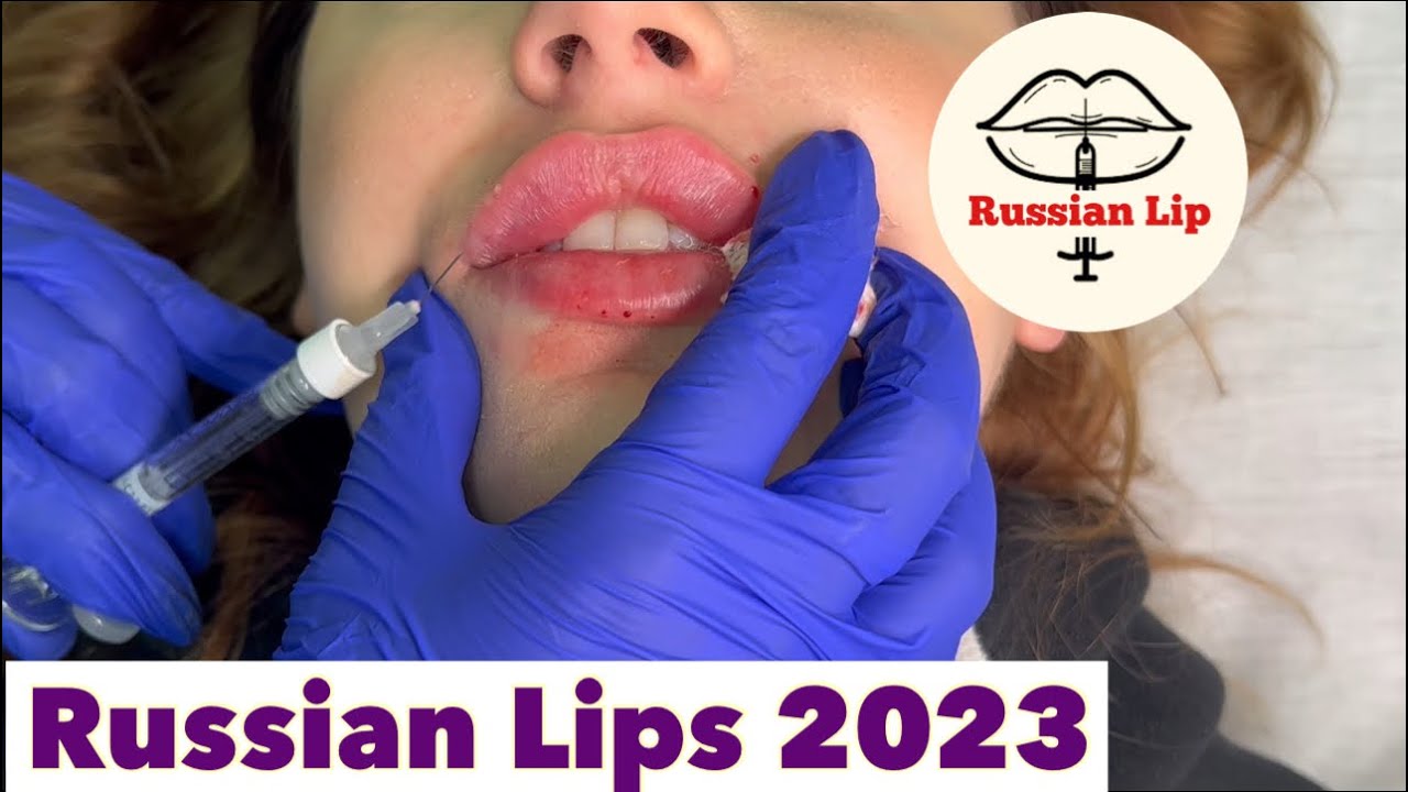 Russian Lips - How to inject Lip Filler