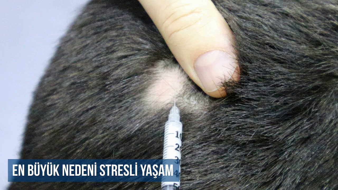 M Hastanesi   Saçkıran  Alopesi Areata