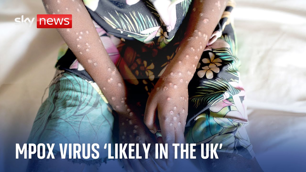 experts-warn-deadly-mpox-virus-is-quite-likely-in-the-uk