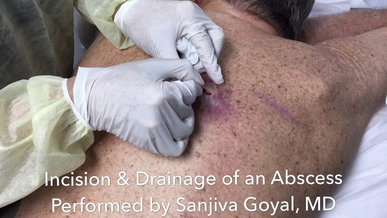 Incision and drainage of a large abscess on the back