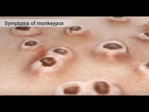 mpox-monkeypox-animation