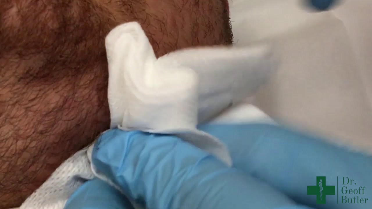Drainage of an Abscess along the Jaw Line