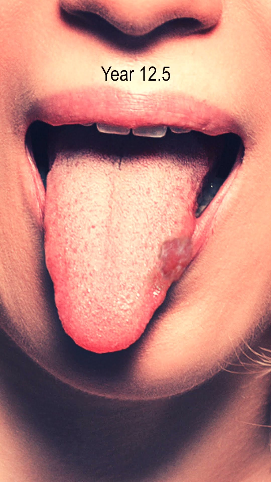 TONGUE CANCER TİME LAPSE