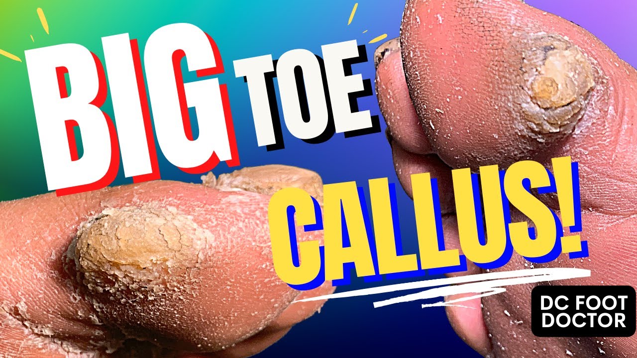 Big Toe Callus