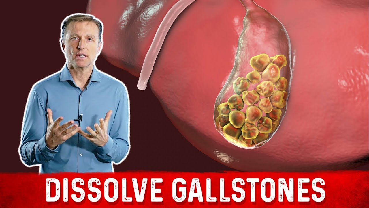 WHAT CAUSES GALLSTONES  HOW TO TREAT THEM – DR.BERG