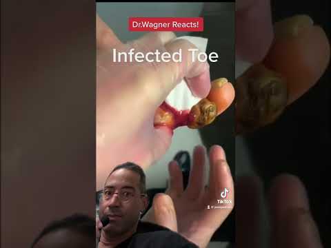 TOE ABSCESS???? #shorts #infection