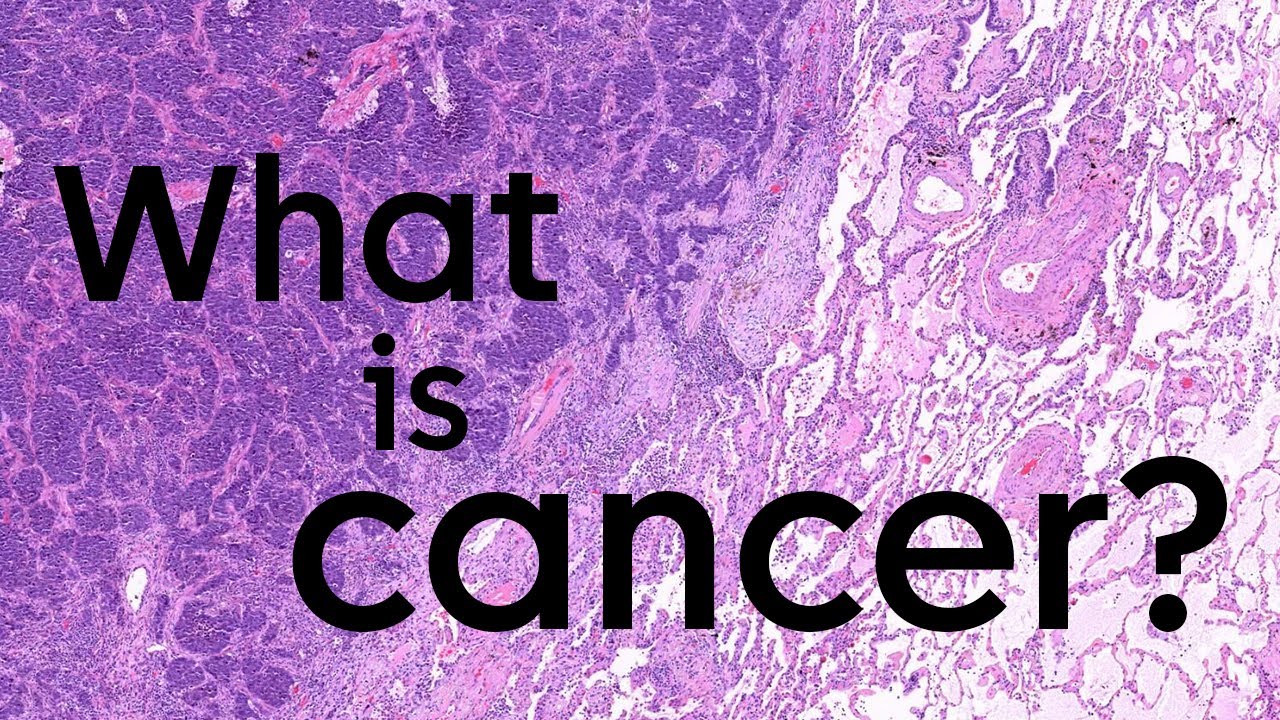 What is cancer and how does it start? | Cancer Research UK