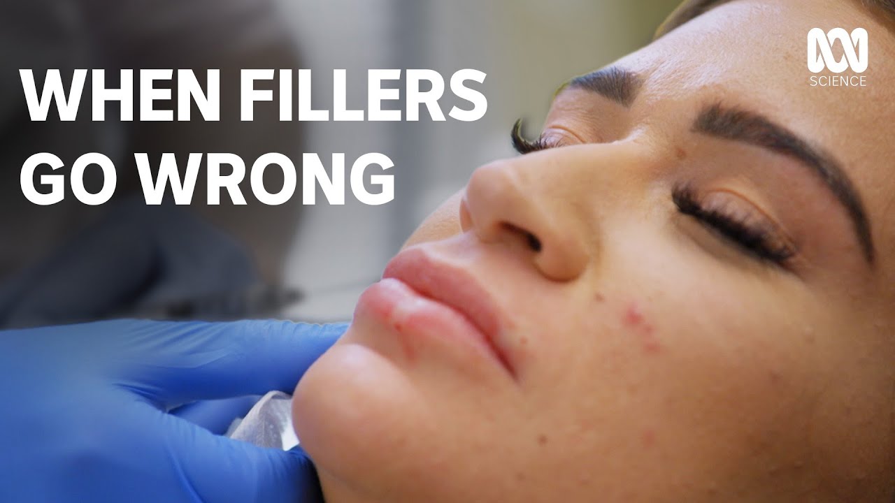 Lip fillers last waaaay longer than you think | Catalyst