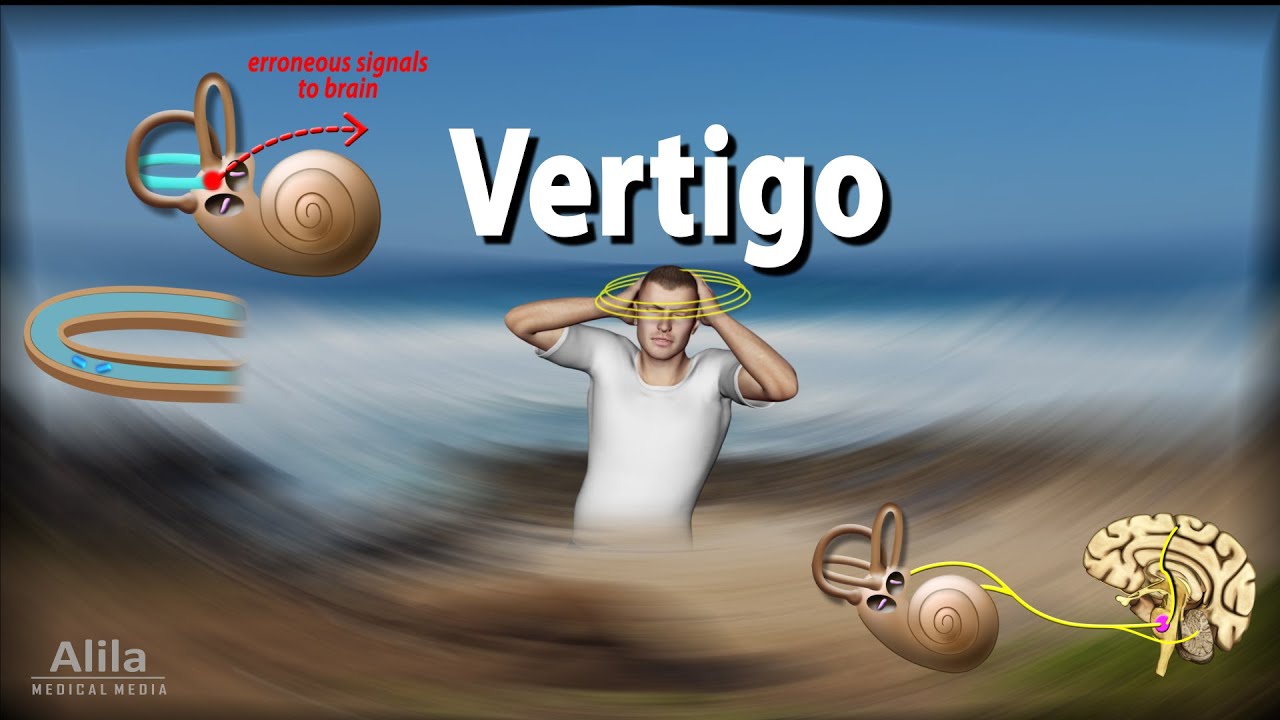 Vertigo: Causes  Pathophysiology and Treatments  Animation