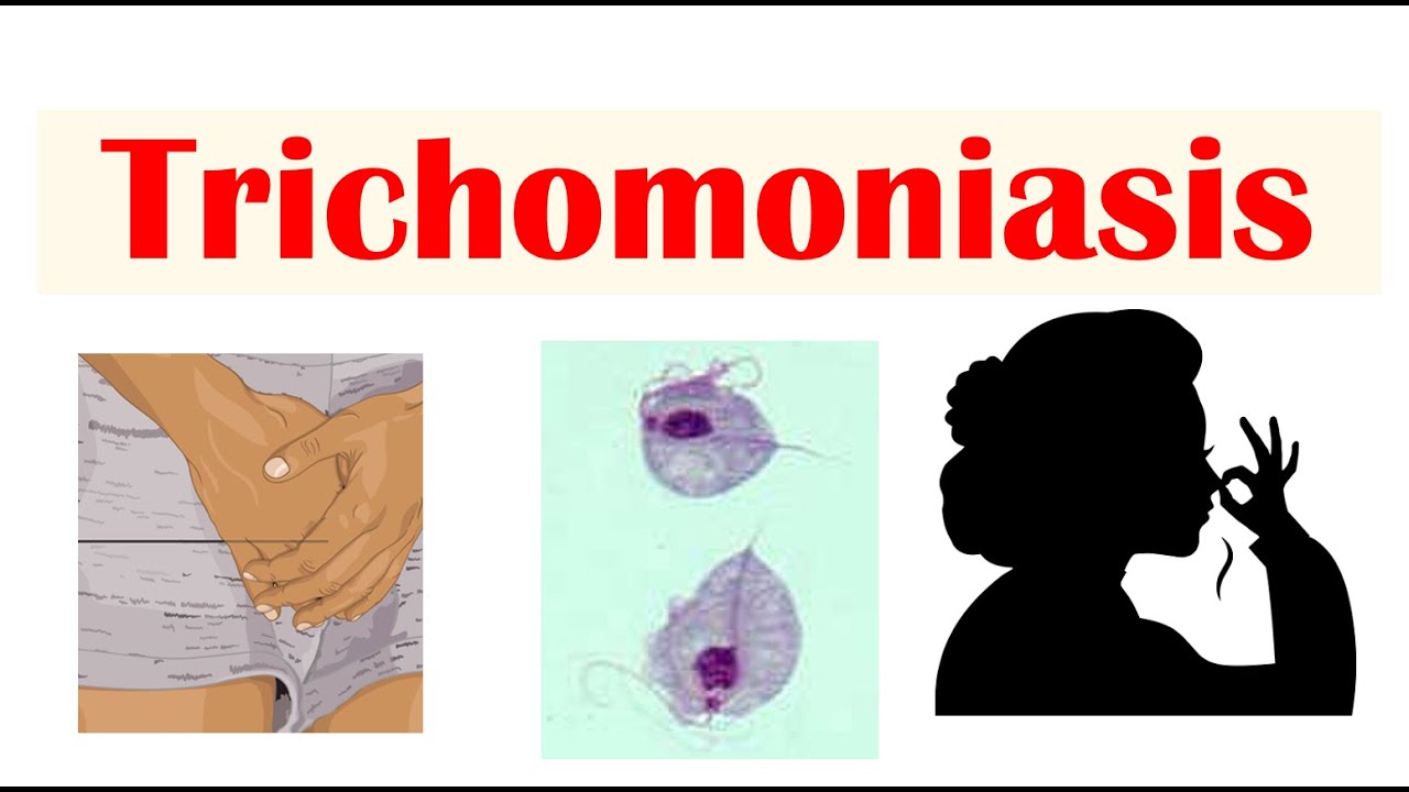 Trichomoniasis (Common STI) | Causes, Symptoms  Complications (Cancer), Diagnosis, Treatment