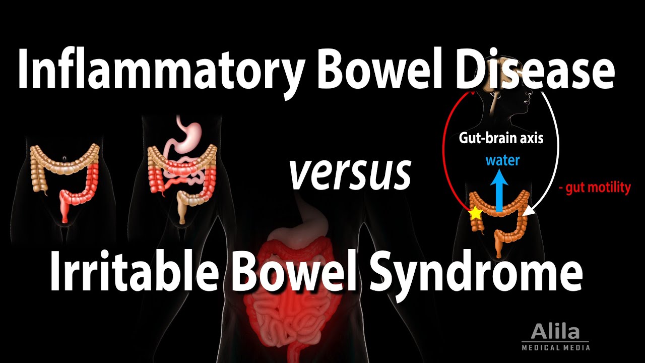 Inflammatory Bowel Disease vs Irritable Bowel Syndrome, Animation