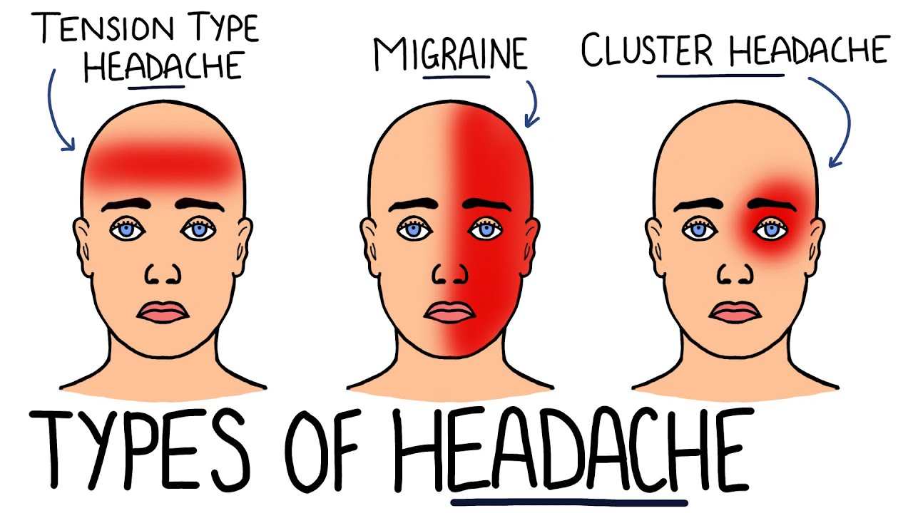 Primary v Secondary Headache (with Red Flags) | Tension Type Headache, Migraine  Cluster Headache