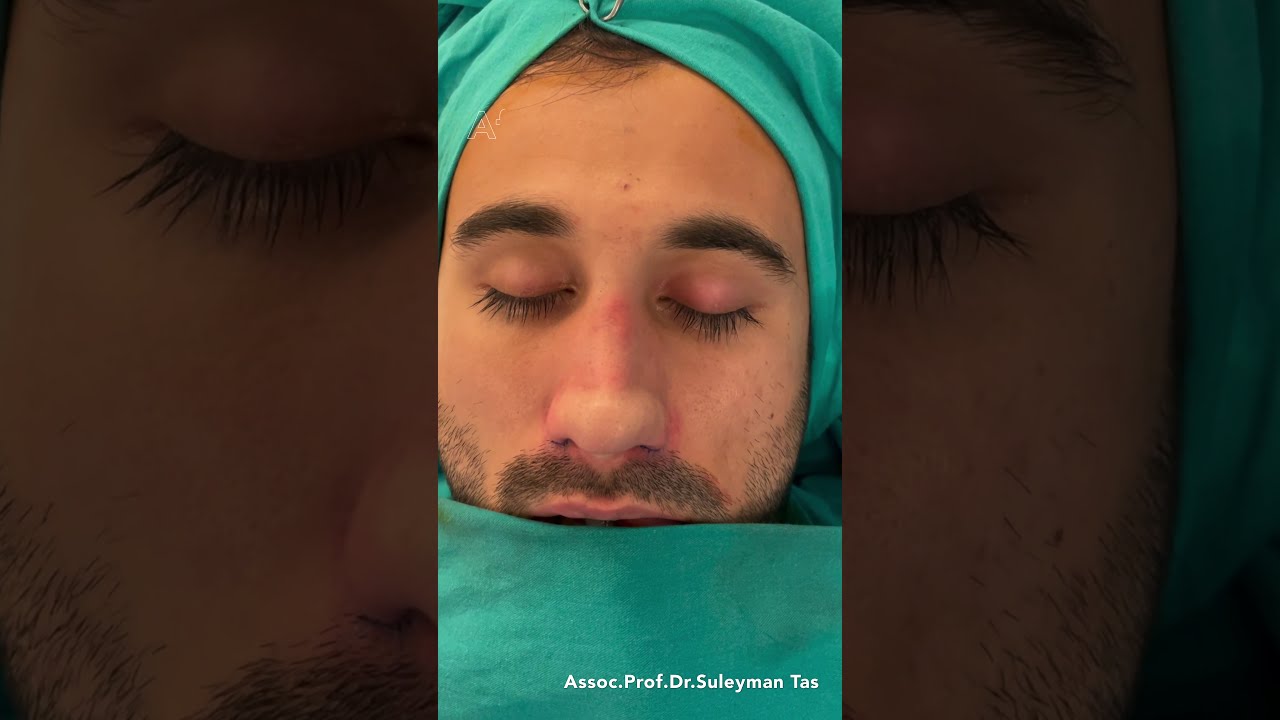 Thick Skinned Male Rhinoplasty | Before and After