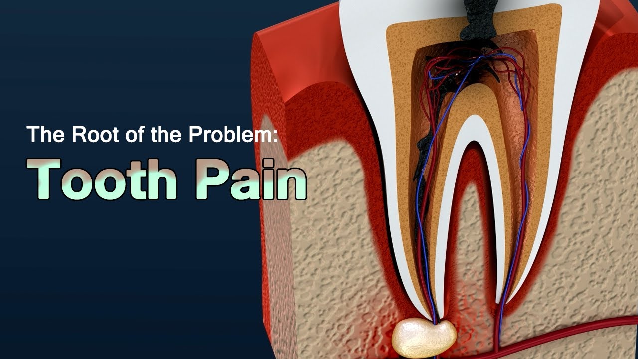 CAUSES OF SEVERE TOOTHACHE AND HOW TO RELİEVE THE PAİN