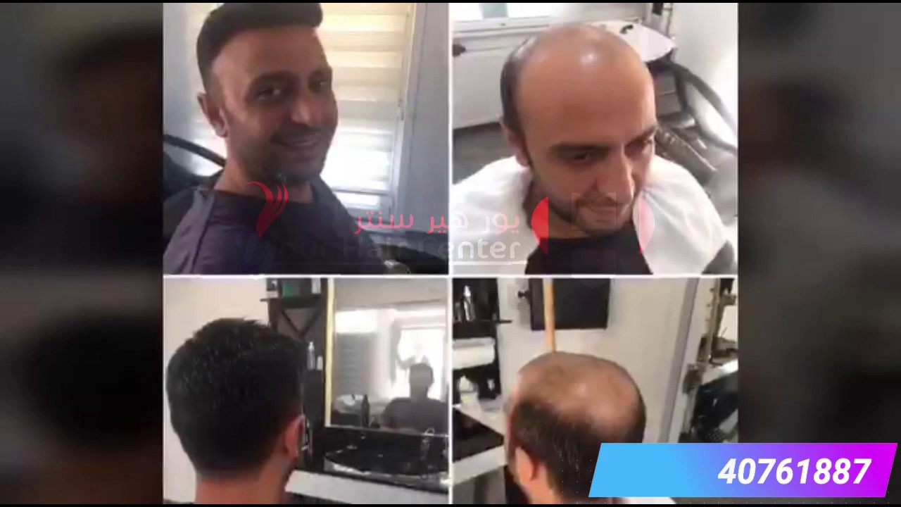 Prosthetic Hair by your hair center