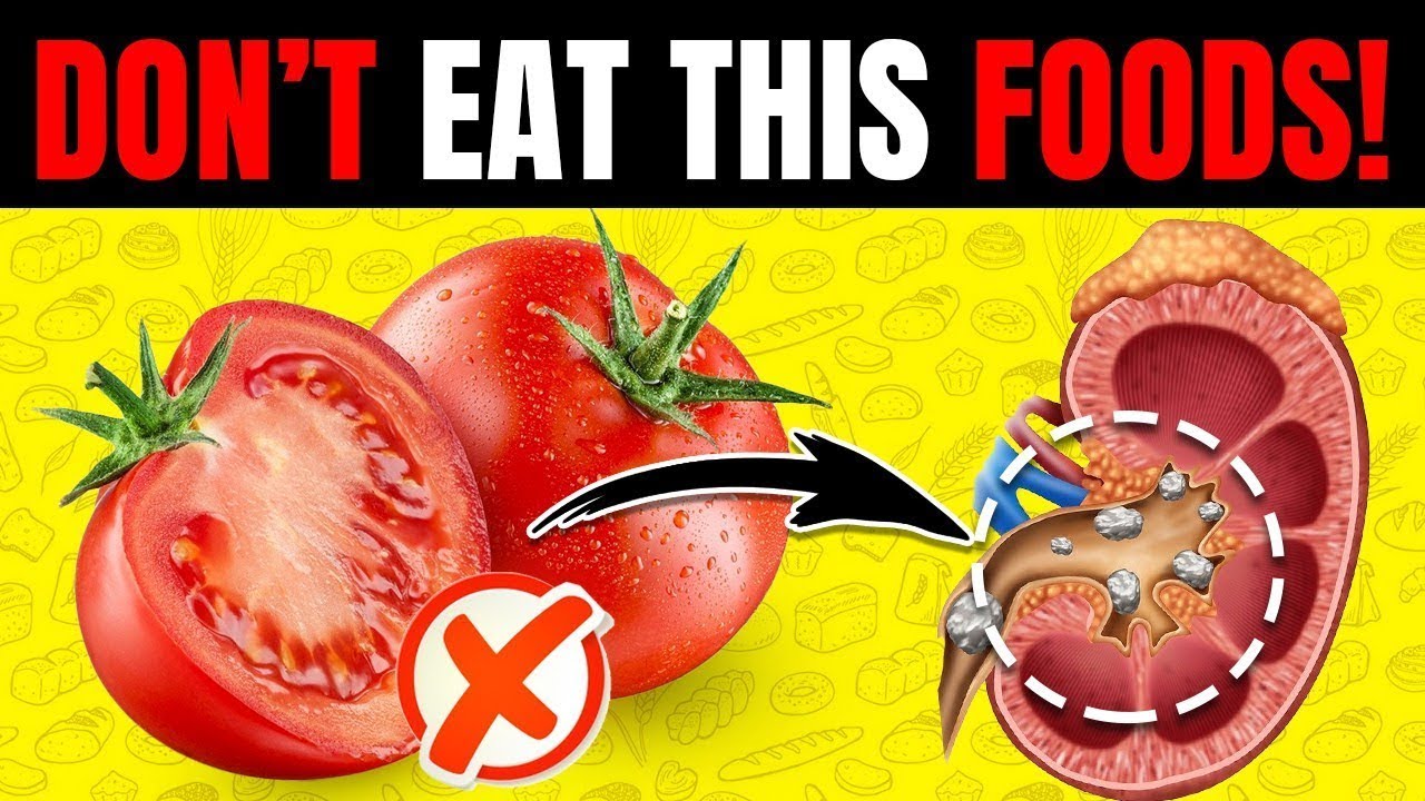 PREVENT PAİNFUL KİDNEY STONES NOW! TOP 15 FOODS YOU SHOULD NEVER EAT | FOCUS.HEALTH