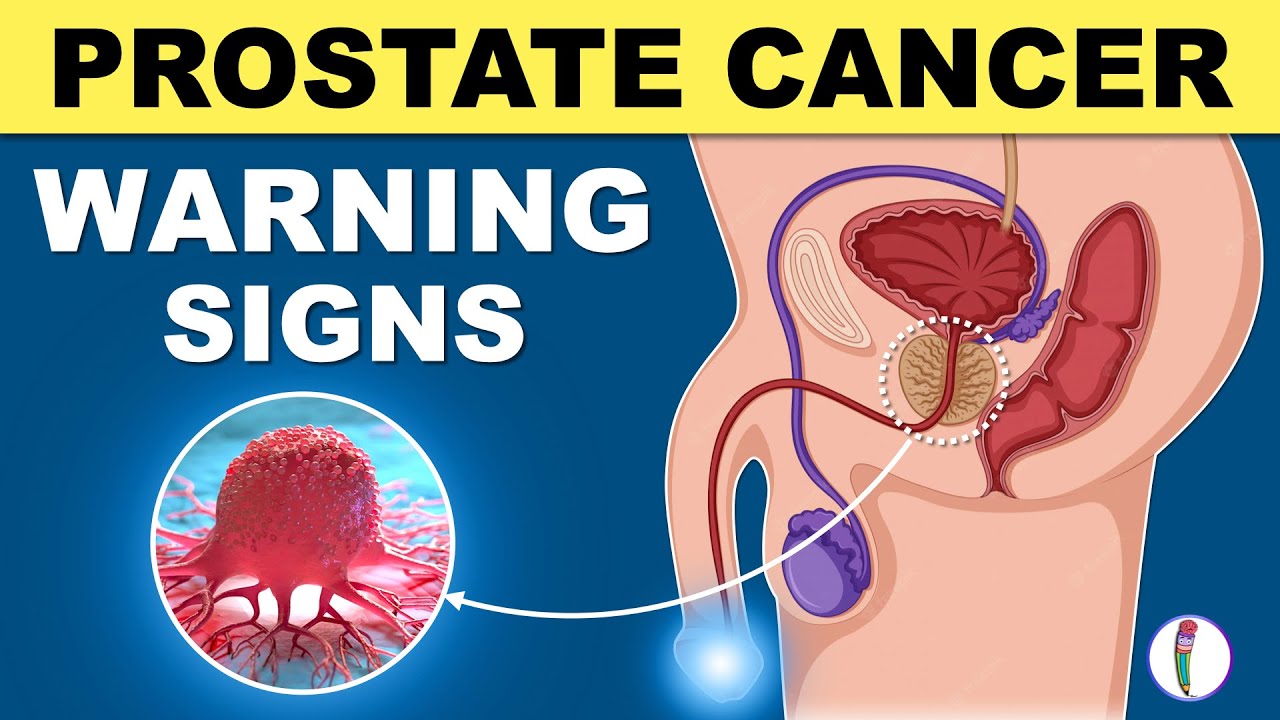PROSTATE CANCER SİGNS | WARNİNG SİGNS OF PROSTATE CANCER