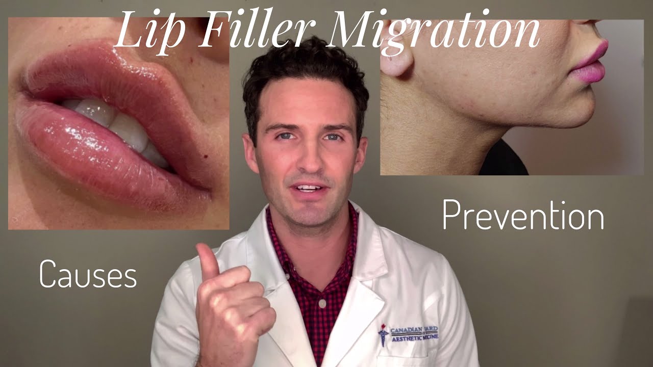 Lip Filler Migration: Causes  Prevention