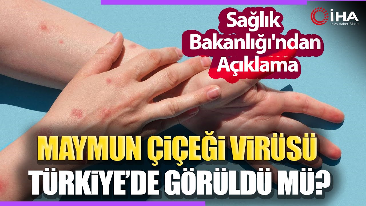 Sağlık Bakanlığı'ndan Maymun Çiçeği Virüsü Açıklaması