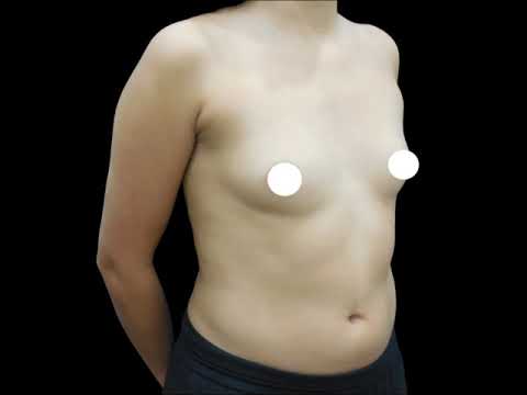 23-Year-Old Silicone Breast Implants Before & After #5048 · Gemini Plastic Surgery