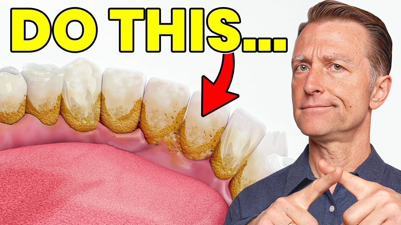 The #1 Top Remedy for Dental Plaque (TARTAR)