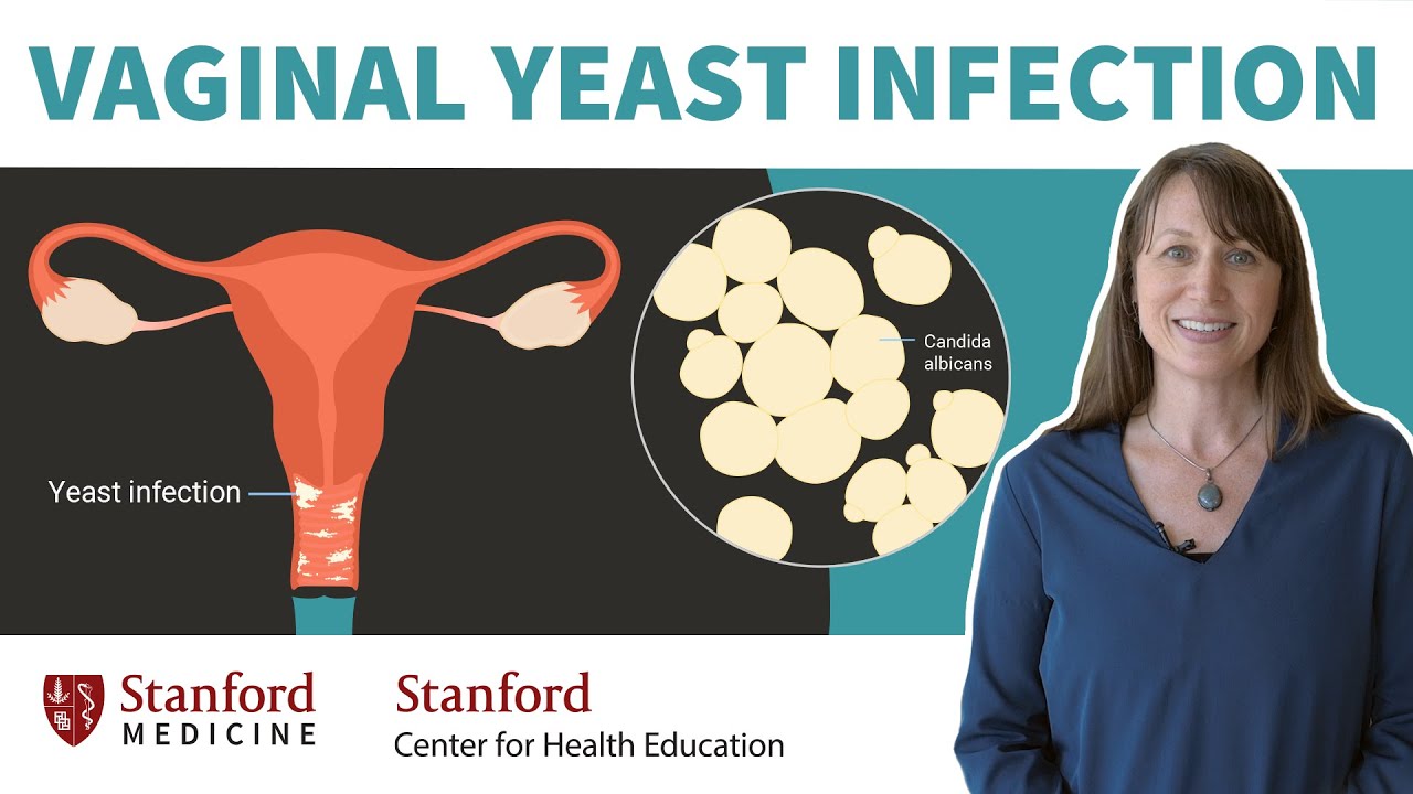 VAGİNAL YEAST İNFECTİON: DOCTOR EXPLAİNS CAUSES, SYMPTOMS,  TREATMENT | STANFORD