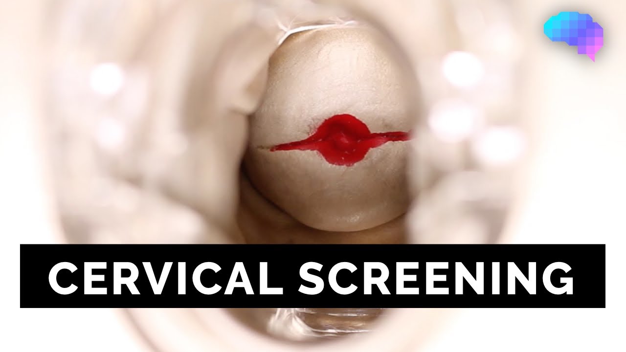 Cervical Screening  SMEAR   OSCE Guide   UKMLA   CPSA