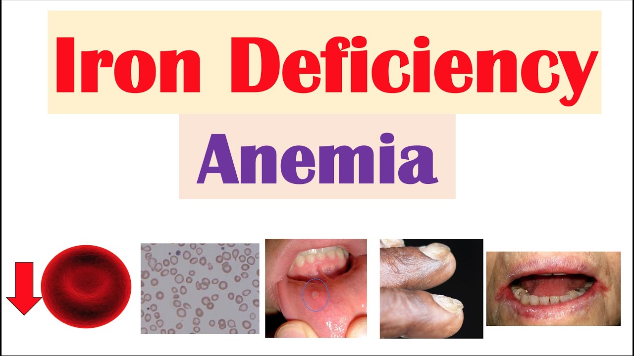 Iron Deficiency Anemia  Overview   Causes  Pathophysiology  Signs   Symptoms  Diagnosis  Treatment