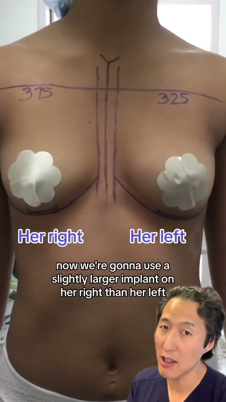 augmentation mammaplasty