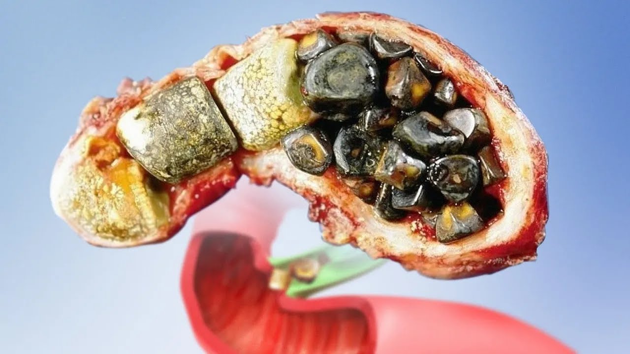 THE FIRST SİGN OF GALLSTONES OVER 80% OF THE TİME