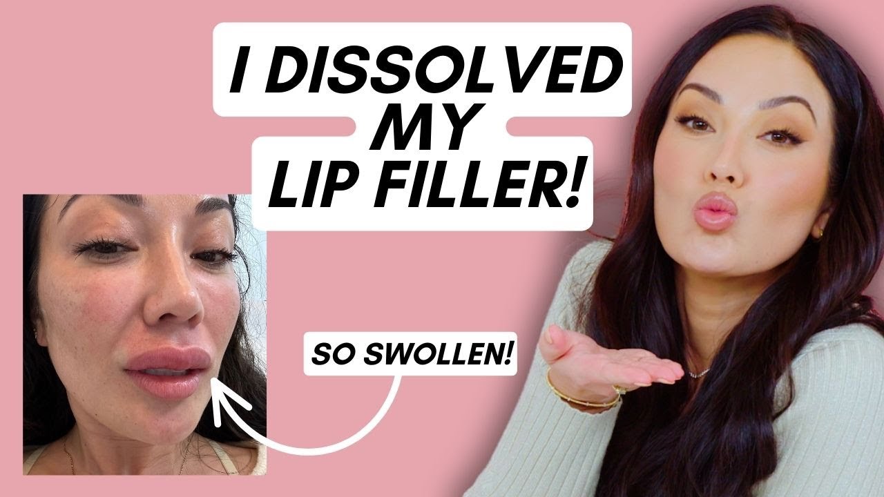 I Dissolved My Lip Filler! Here's Why... | Beauty with Susan Yara