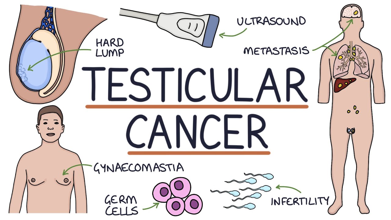 Understanding Testicular Cancer