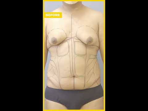 TRANSGENDER 360° TRANSFORMATİON CARE BEFORE  AFTER RESULTS #LİPOSUCTİON #HOURGLASS #SHORTS