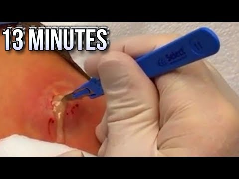 13 MİNUTES OF YOUTUBE'S BEST ABSCESSES!  WHAT İS AN ABSCESS?