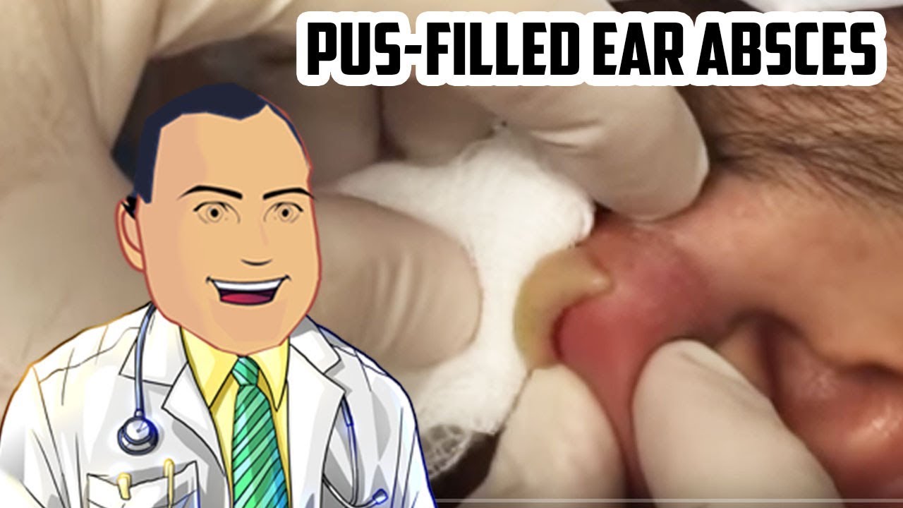 Pus-Filled Ear Abscess Drained - Revisited Popping