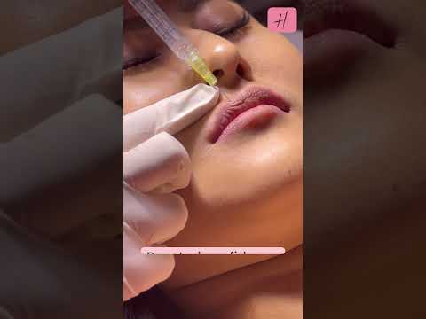 Improved Lip Shape by Fillers Live Procedure | #shorts #shortsfeed #lipfiller
