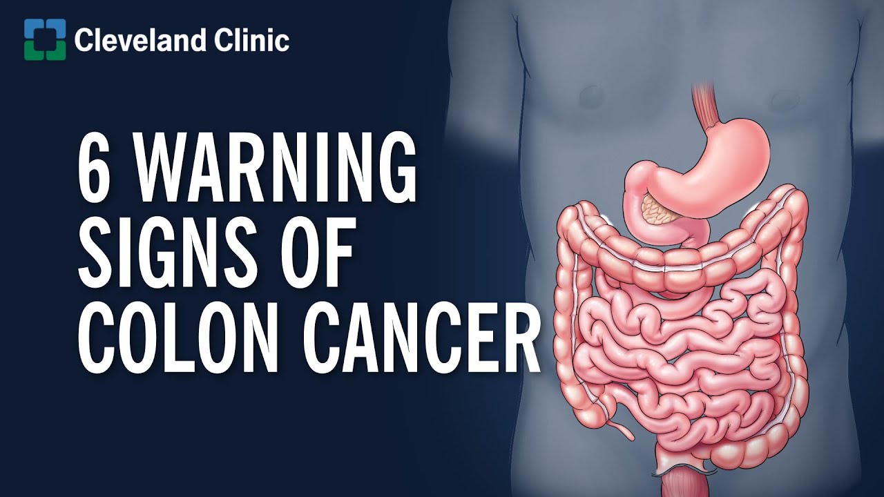 6 WARNİNG SİGNS OF COLON CANCER