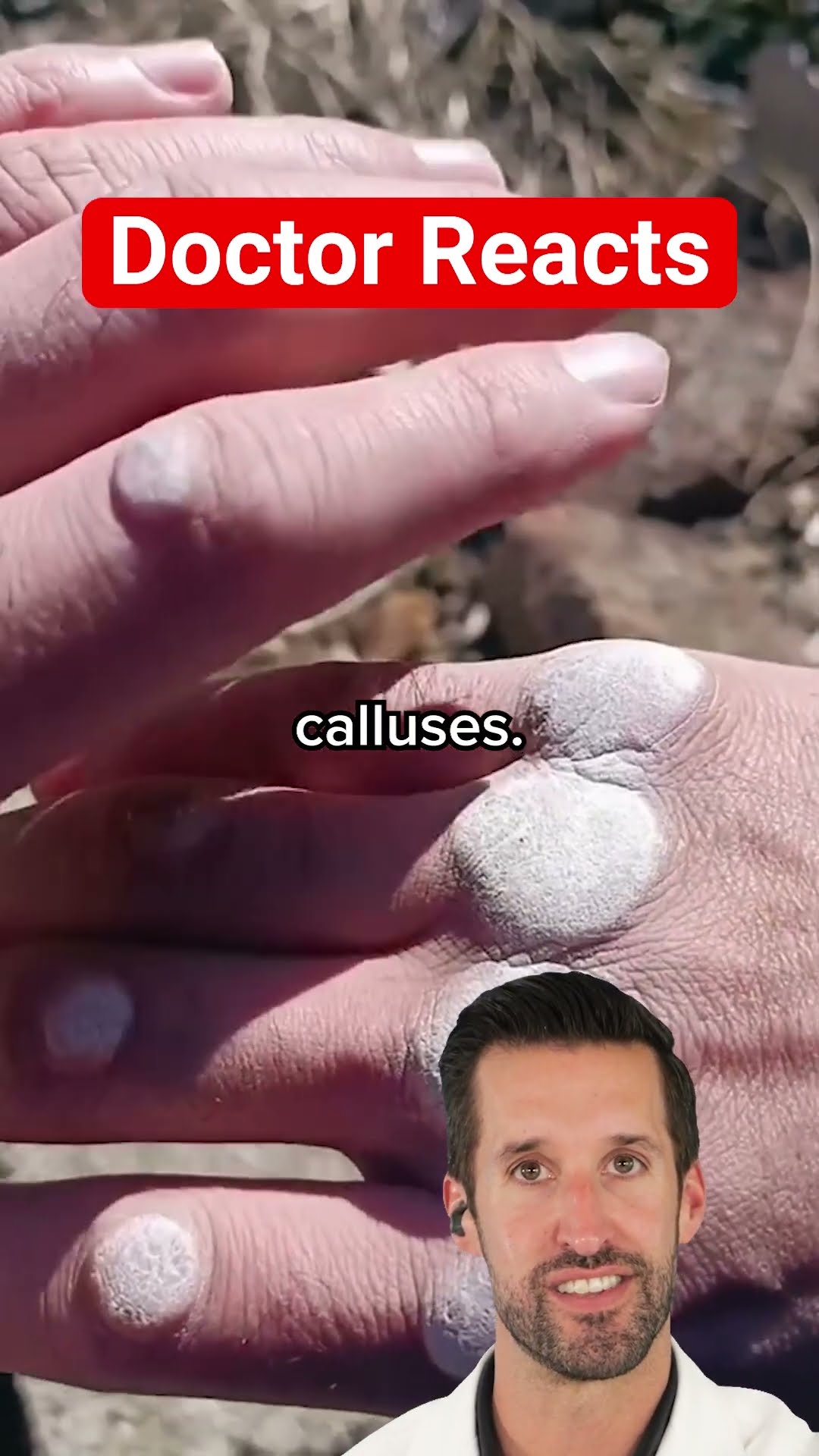 ER Doctor REACTS to World's Largest Hand Callus