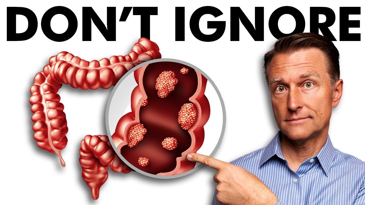 The Early Signs of Colon Cancer You DON'T Want to Ignore