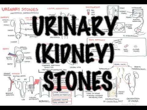 URİNARY/KİDNEY STONES - OVERVİEW (SİGNS AND SYMPTOMS, RİSK FACTORS, PATHOPHYSİOLOGY, TREATMENT)