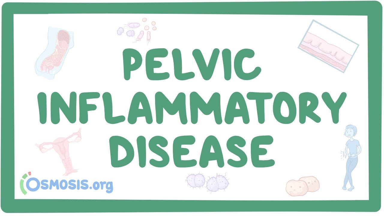 Pelvic inflammatory disease - causes, symptoms, diagnosis, treatment, pathology