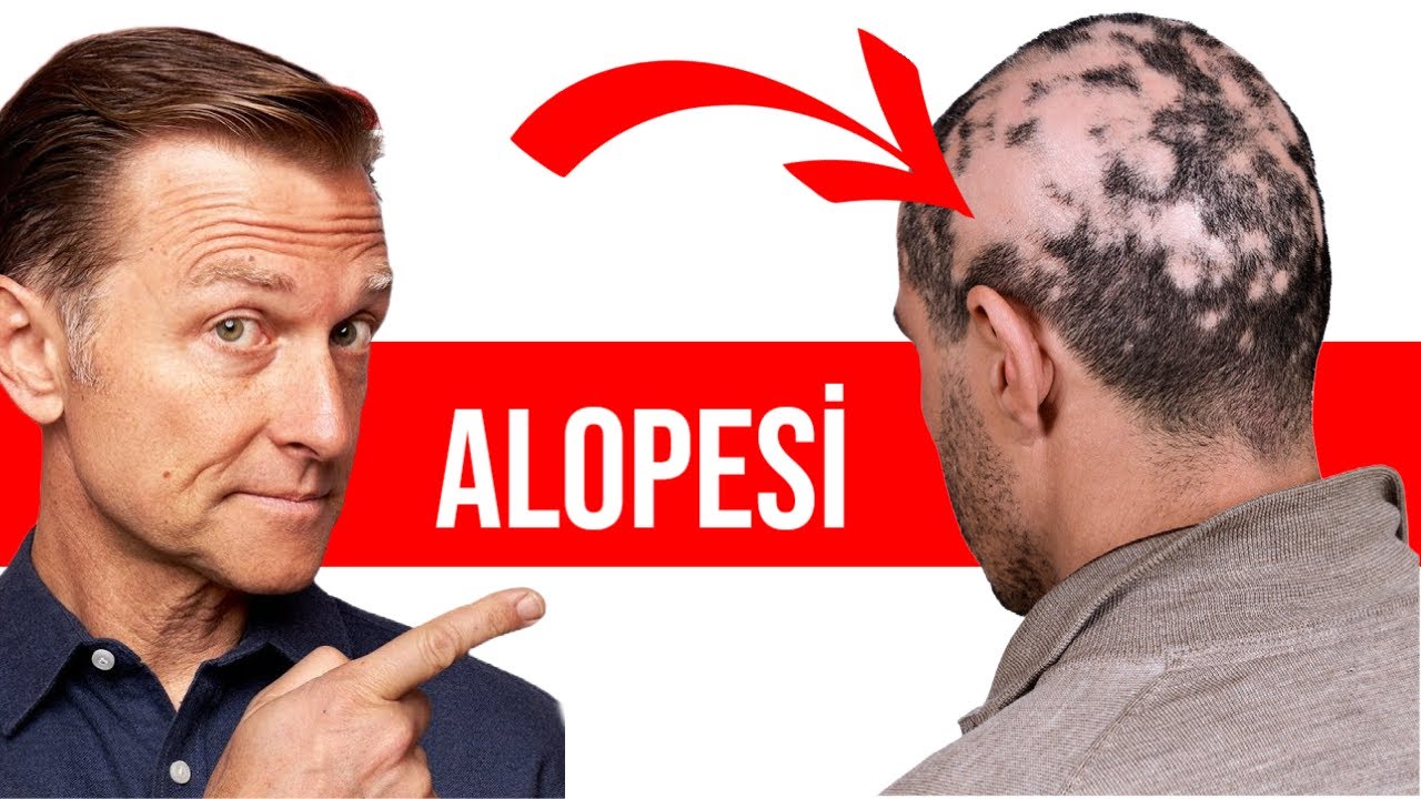 Alopesi Areata  Saçkıran Tedavisine Yardımcı Olan Üç Eser Mineral   DrBerg Türkçe